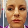 Image 5: Enhance Natural Beauty with Expert Dermal Filler Injections(0.5ml–2ml)