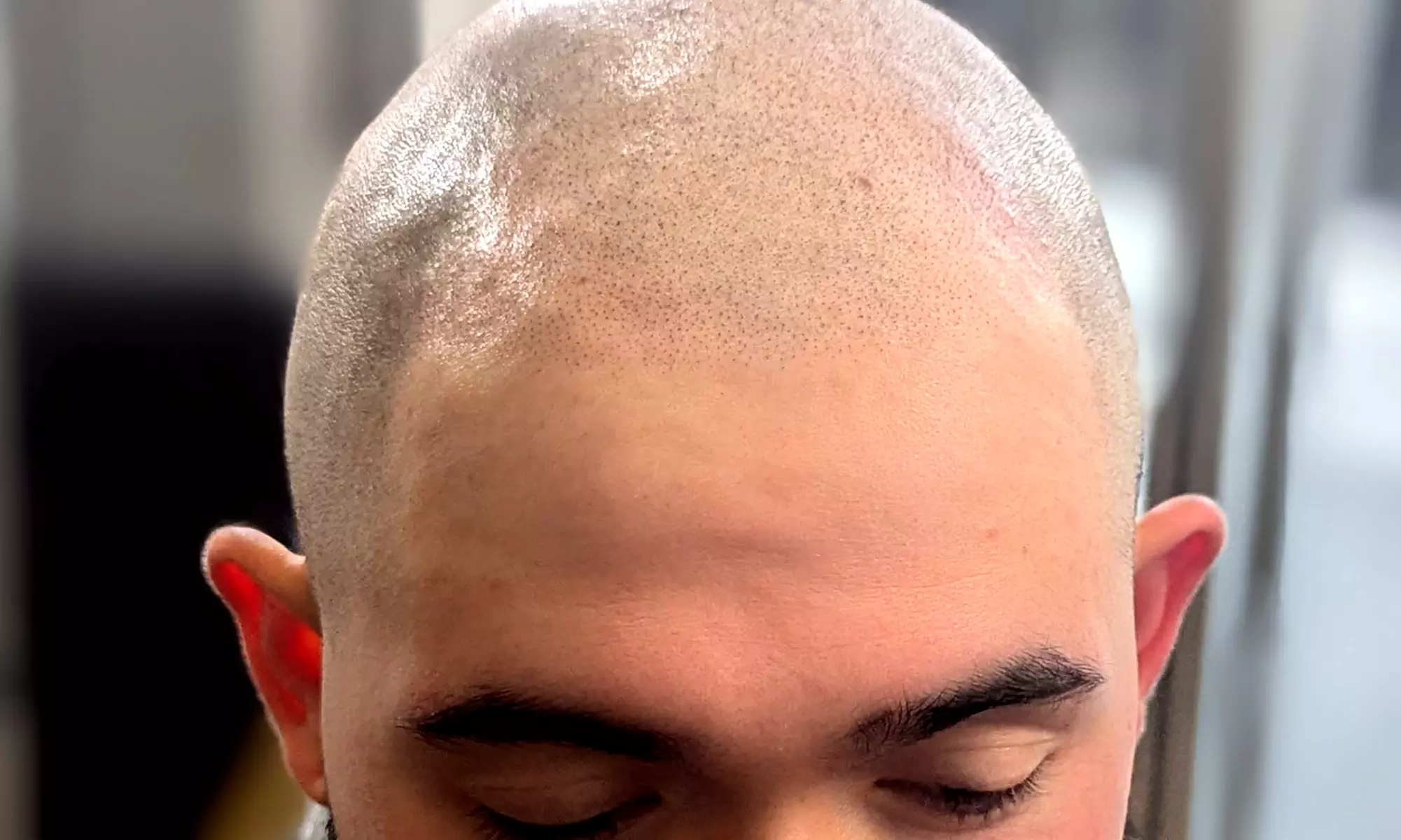 Scalp Micropigmentation Hair Loss, Balding, or Thinning Treatment
