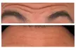 Transform Your Look with 30 or 60 Units of Dysport at Youthful Glow ( Up to 51% Off ) - Second Medium