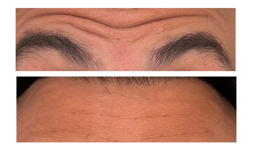 Image 5: Revitalize with 30 or 60 Units of Dysport at Youthful Glow