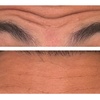 Image 5: Revitalize with 30 or 60 Units of Dysport at Youthful Glow