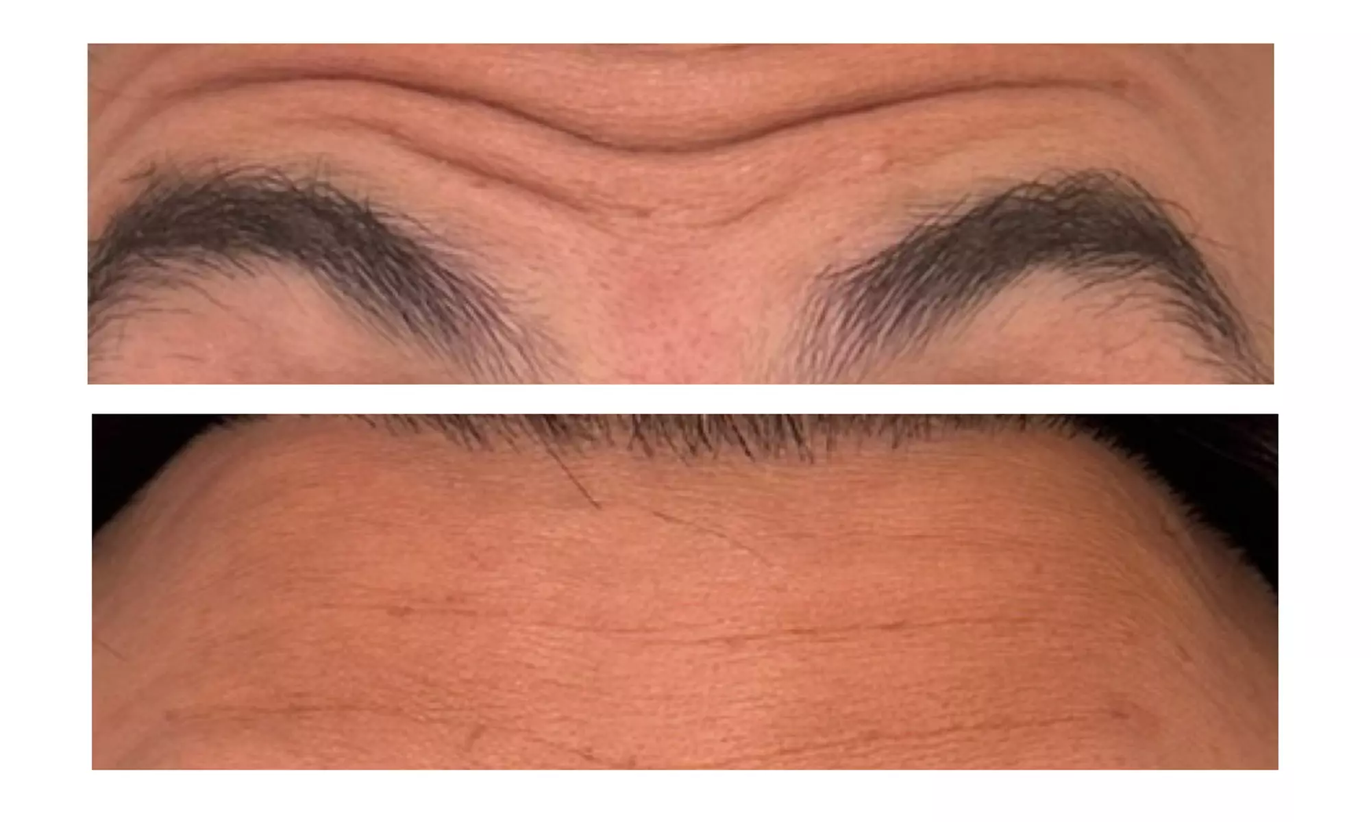 Revitalize with 30 or 60 Units of Dysport at Youthful Glow