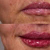 Image 2: Enhance Your Look with 0.5ml or 1ml of Dermal Fillers Options 