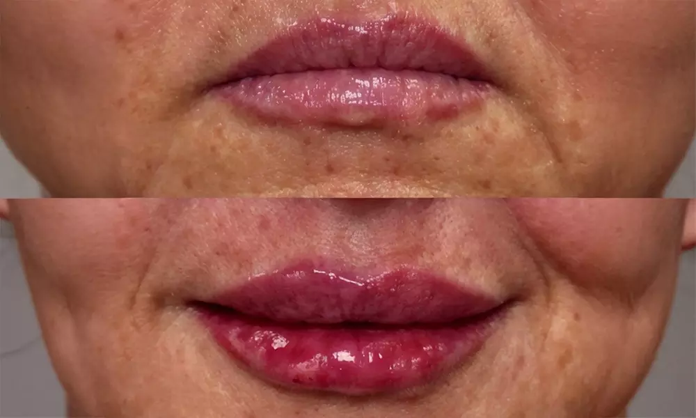 Enhance Your Look with 0.5ml or 1ml of Dermal Fillers Options