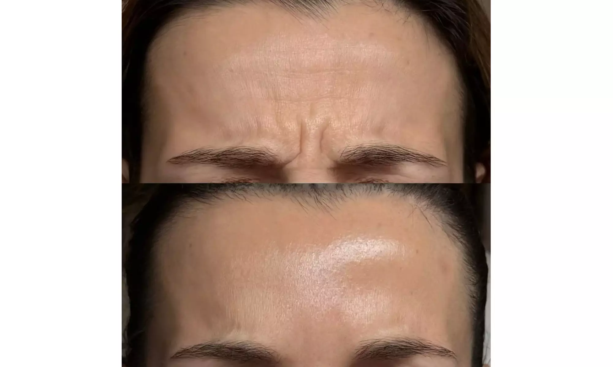 Enhance Your Look with 20, 40, or 60 Units of Botox