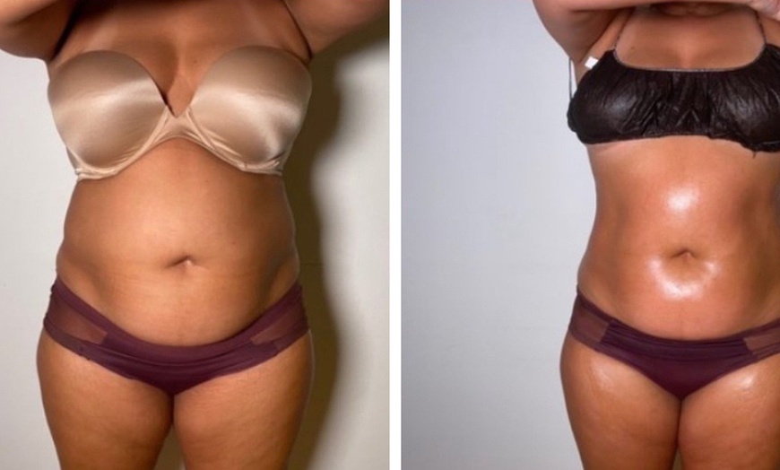 Image 2: Deluxe Lymphatic Drainage & Body Sculpt Sessions