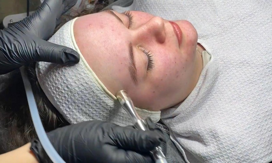 Image 1: Klassische Gesichtsbehandlung, Mikrodermabrasion oder Microneedling