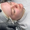 Image 1: Klassische Gesichtsbehandlung, Mikrodermabrasion oder Microneedling