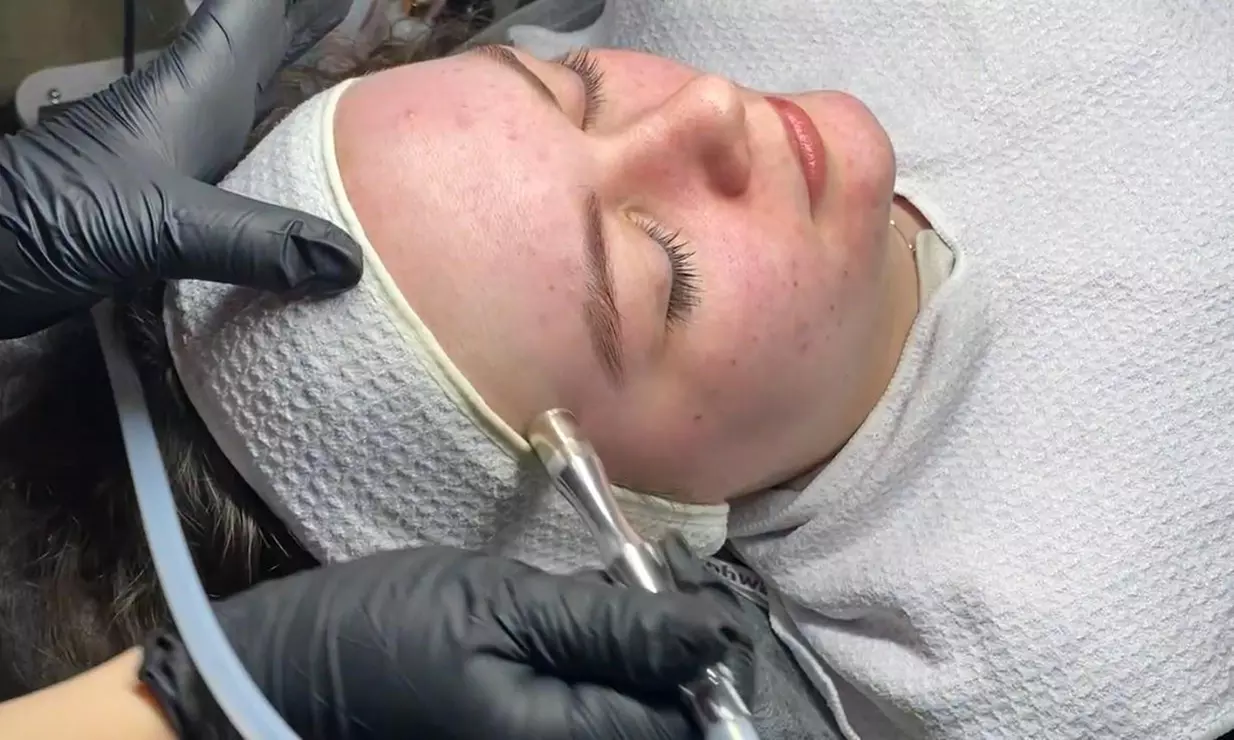 Klassische Gesichtsbehandlung, Mikrodermabrasion oder Microneedling
