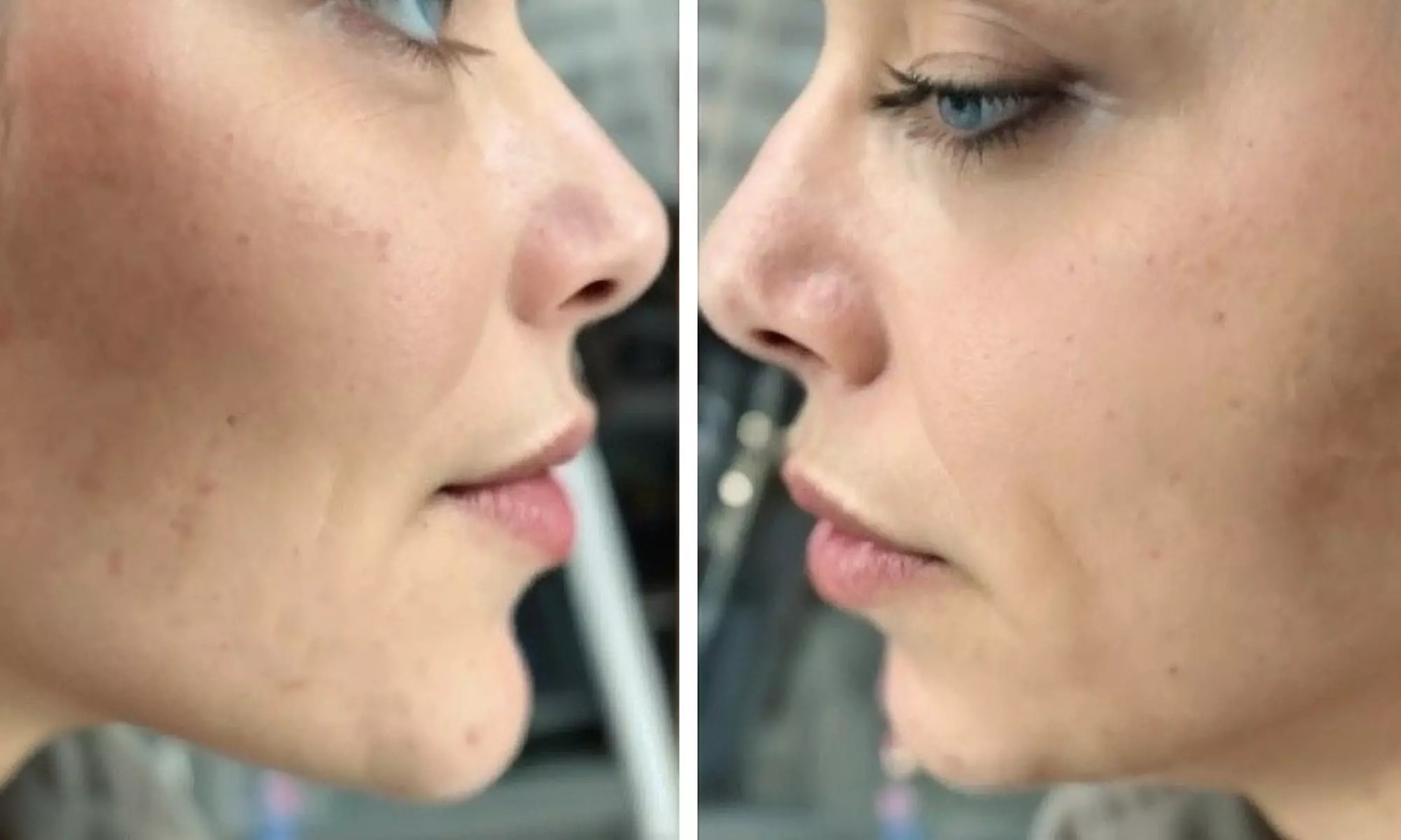 Enhance Your Look with 0.5ml, 1ml or 2ml Dermal Filler