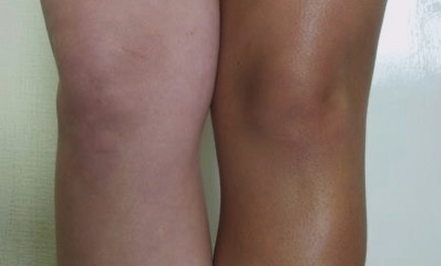 Image 2: 12-Week Acne Bootcamp with Personalized Skin Care and Weekly Check-Ins