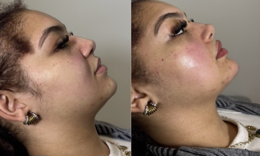 Image 3: Up to 60% Off on Injection - Dermal Filler at Morgan Taylor Beauty Lounge