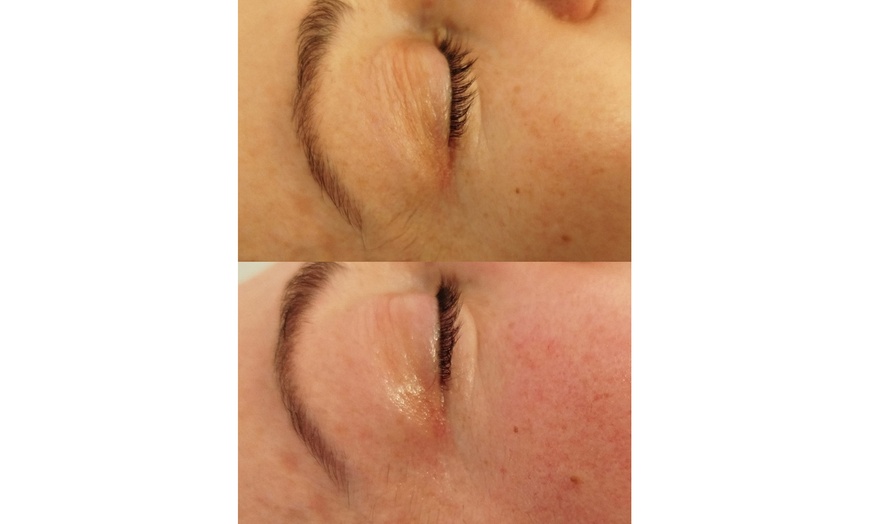 Image 9: 1 o 2 sesiones de radiofrecuencia facial o corporal Indiba