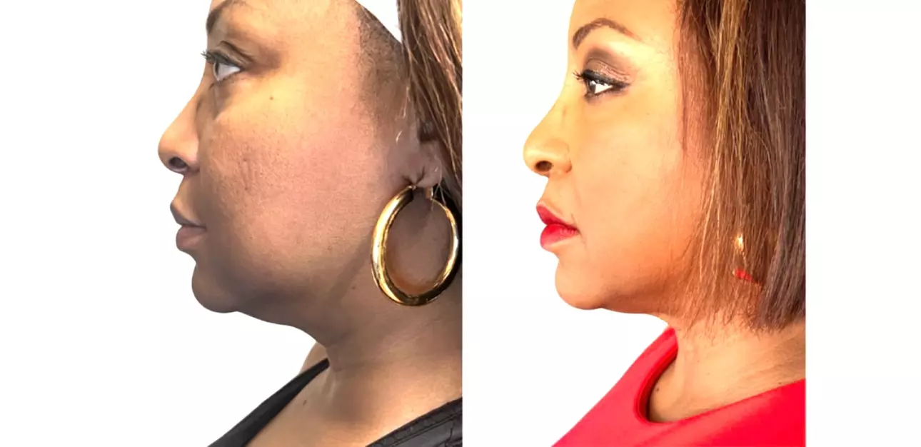 Non Surgical Face Lift with Optional Advanced Skin Tightening