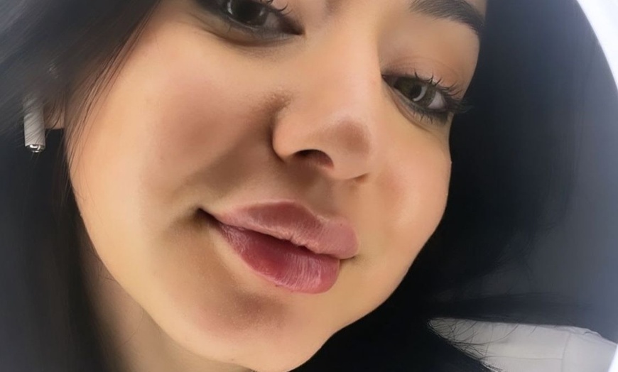 Image 3: Targeted Dermal Filler Treatments for Lips, Eyes & Facial Lines