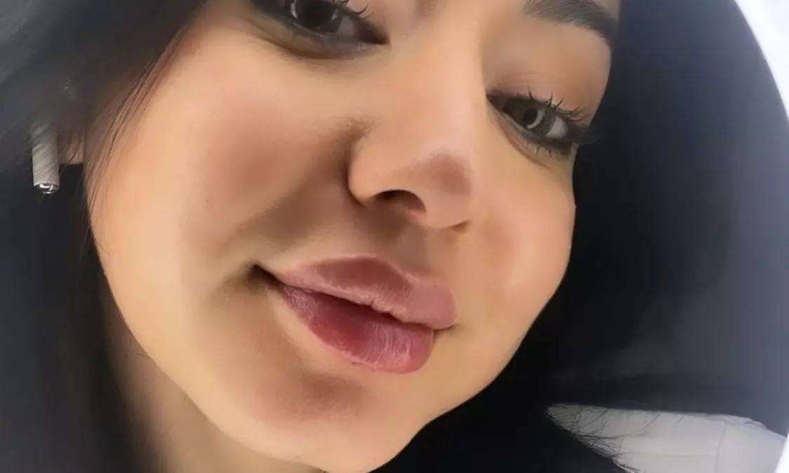 Targeted Dermal Filler Treatments for Lips, Eyes & Facial Lines