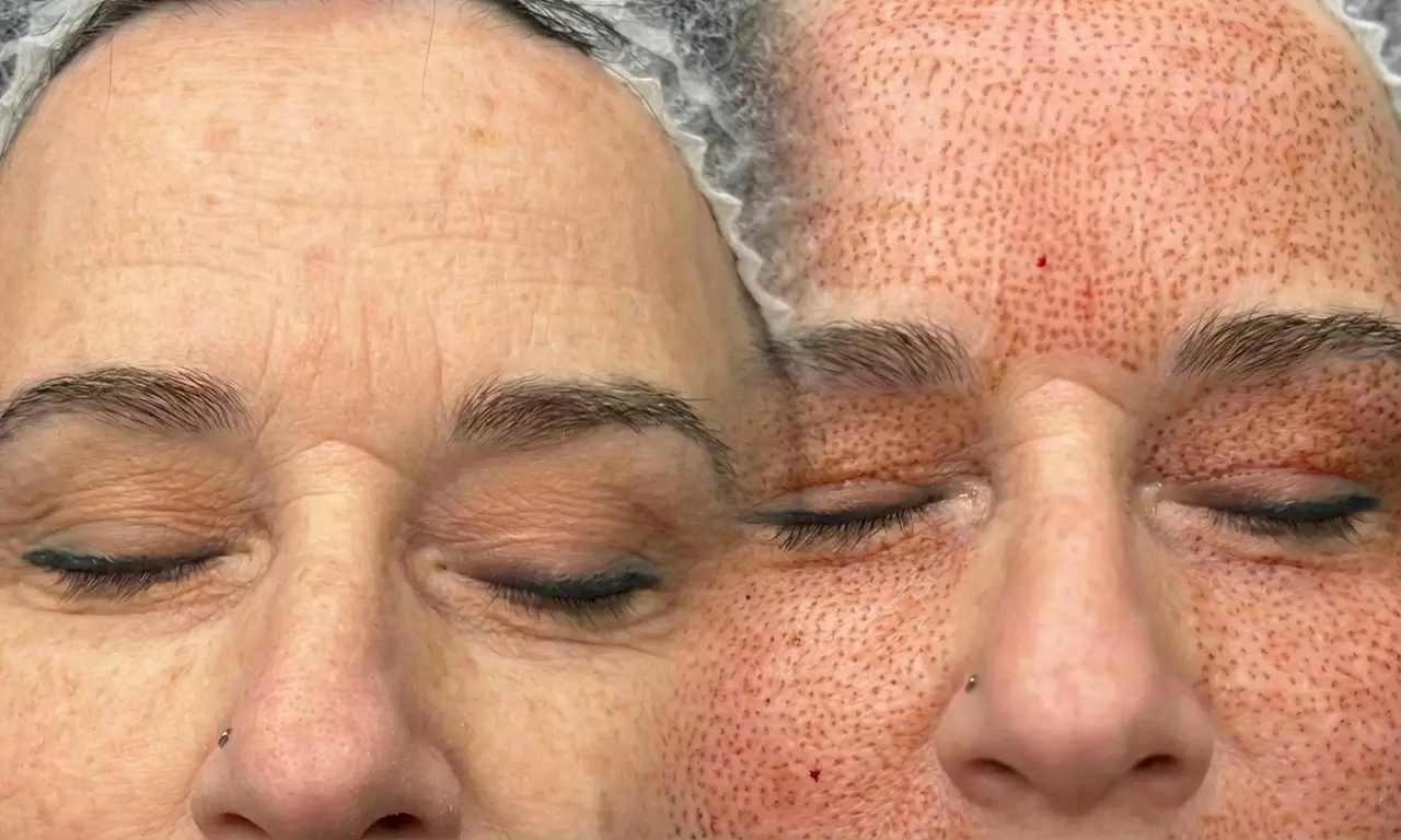 1 o 2 sesiones de plasma pen en zona a elegir para 1 persona