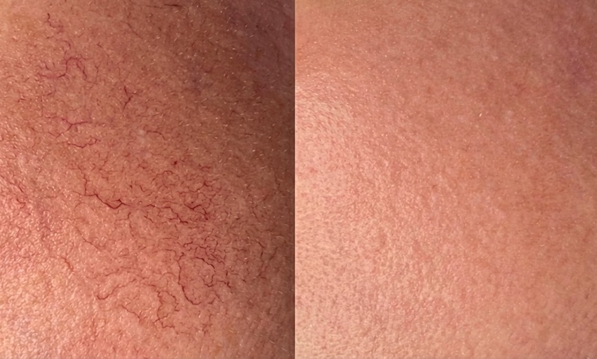 Image 4: Rejuvenate with One IPL Photo Facial for Face, Neck and Optional Chest