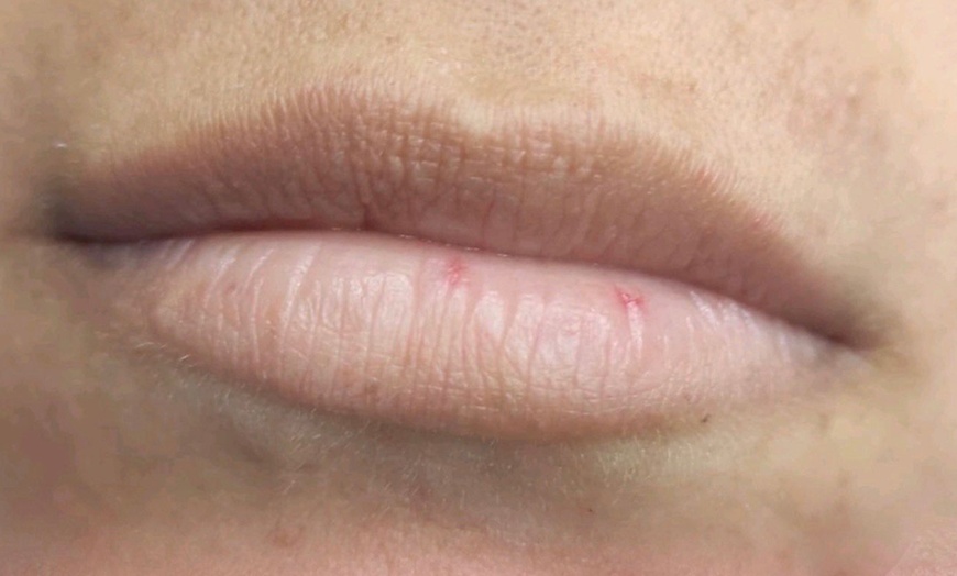 Image 12: Hyaluronpen con hidratación o relleno de labios y reafirmación facial