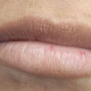 Image 12: Hyaluronpen con hidratación o relleno de labios y reafirmación facial