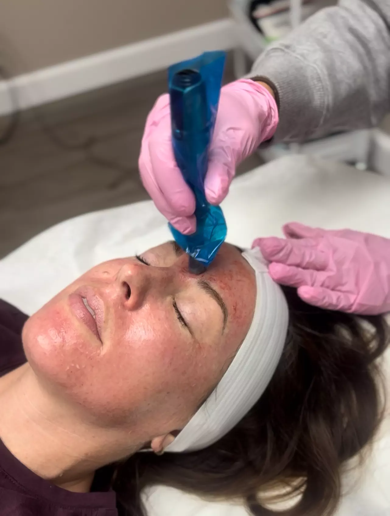 Rejuvenate Your Skin with Microneedling Options