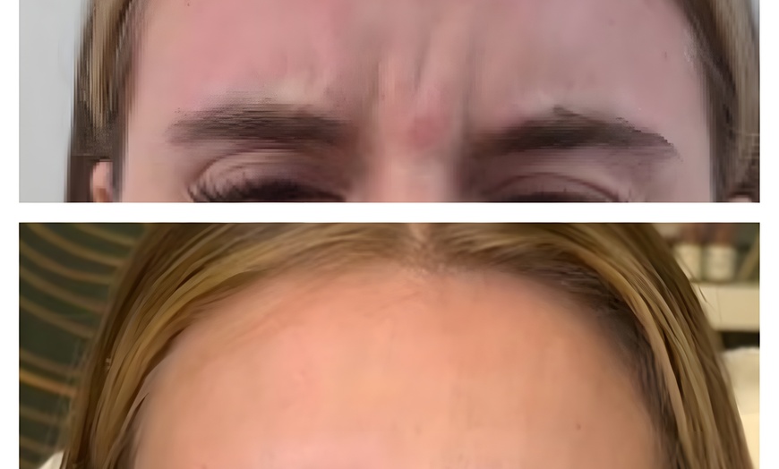 Image 1:  Maintain Youthful Skin: 20 or 40  Units of Jeuveau - 1 or 3 Sessions