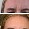 Image 1:  Maintain Youthful Skin: 20 or 40  Units of Jeuveau - 1 or 3 Sessions
