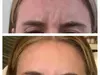 Maintain Youthful Skin: 20 or 40  Units of Jeuveau - Single or Three Sessions - Up to 50% Off