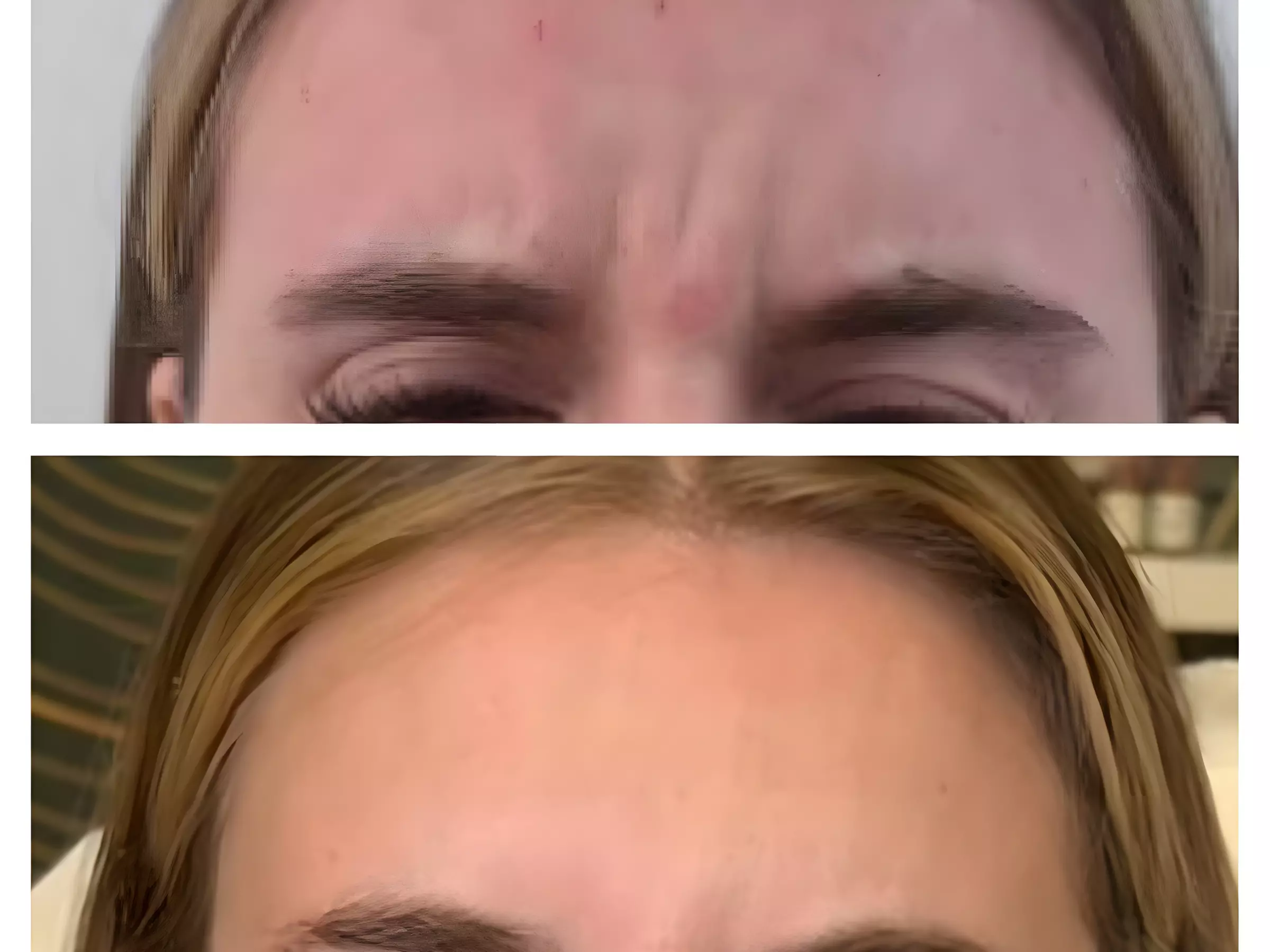  Maintain Youthful Skin: 20 or 40  Units of Jeuveau - 1 or 3 Sessions