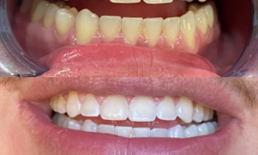 Image 2: Professional Teeth Whitening Treatments