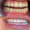Image 2: Professional Teeth Whitening Treatments