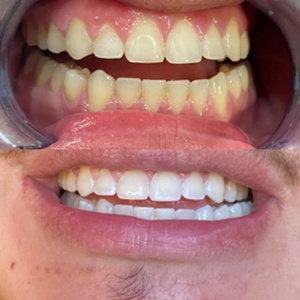 45 Minute In-Office Teeth-Whitening Touchup - Teeth whitening Graceful Gloww by Lizzie