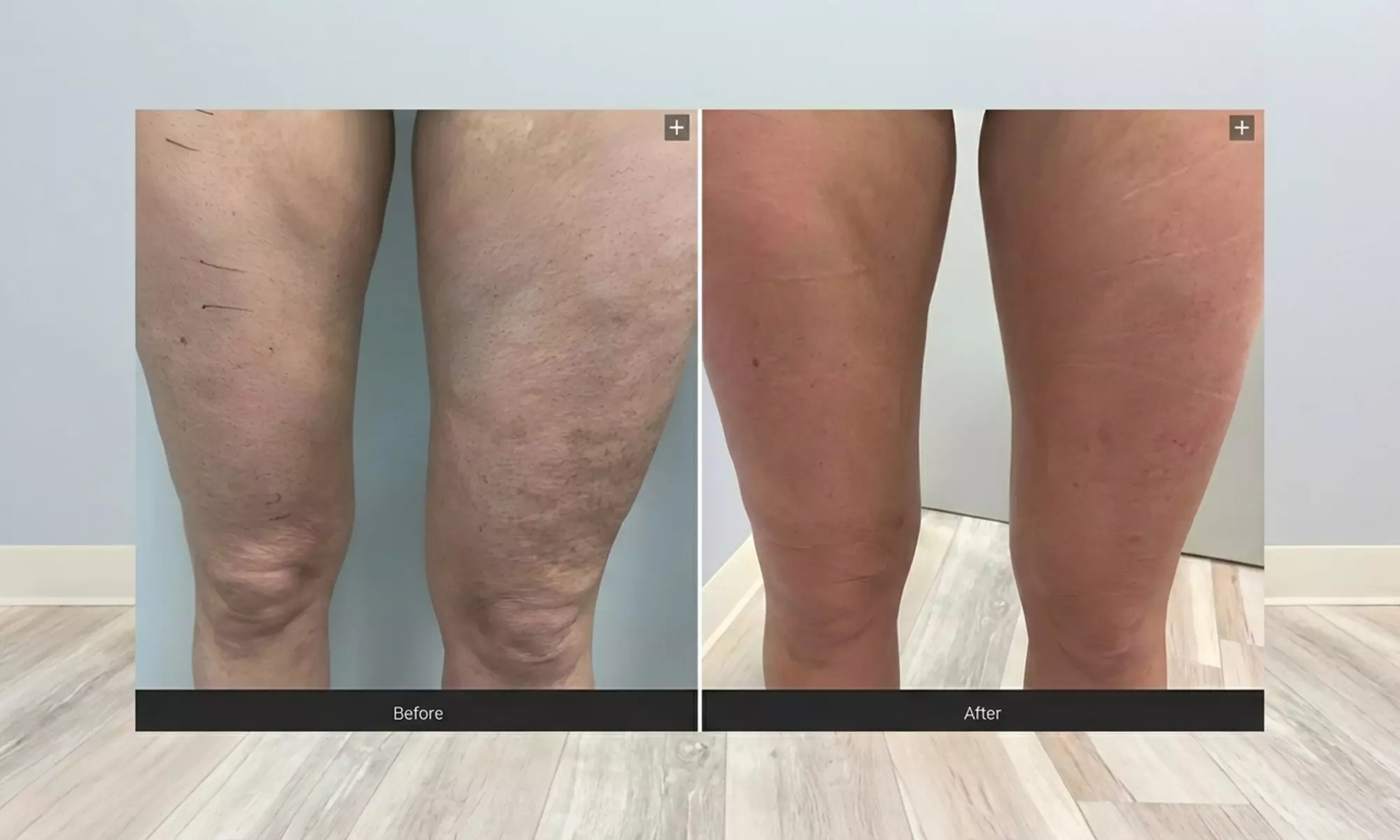 VelaShape Sessions for Targeted Body Contouring & Cellulite Reduction