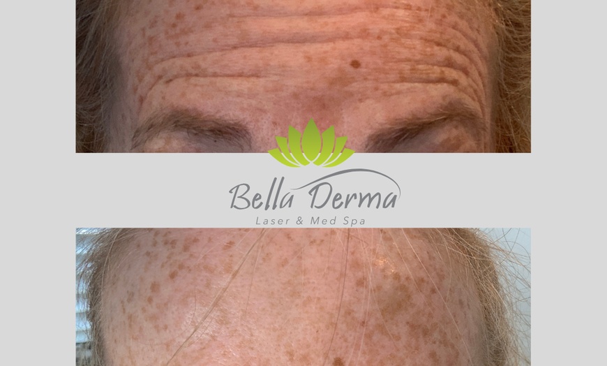 Image 6: Smooth Fine Lines & Wrinkles with Professional Botox Injections