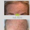 Image 6: Smooth Fine Lines & Wrinkles with Professional Botox Injections