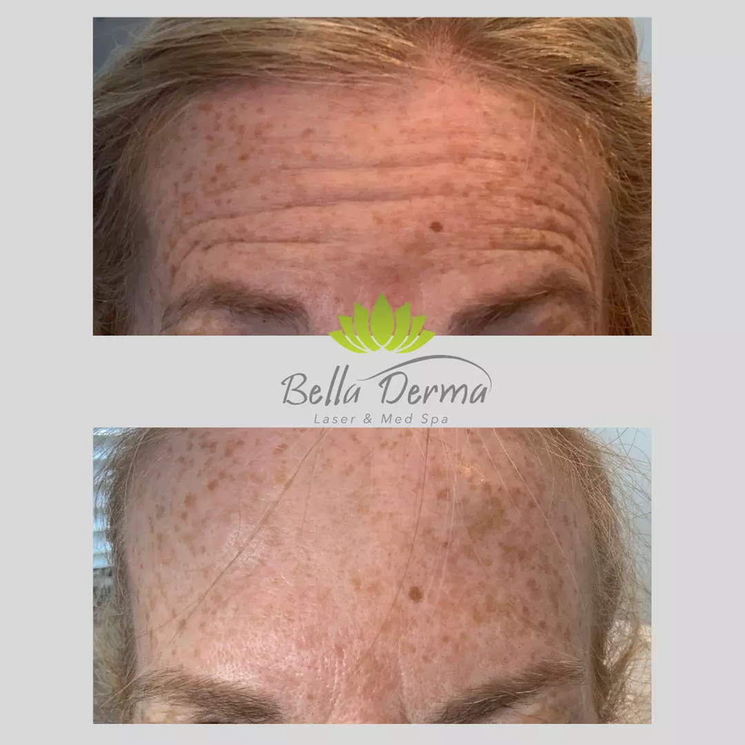 Smooth Fine Lines & Wrinkles with Professional Botox Injections