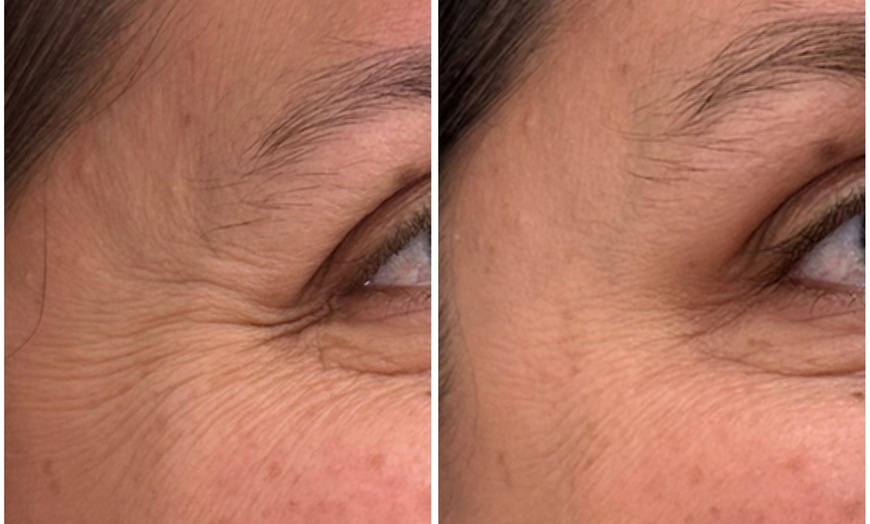 Image 8: Revitalize with 30 or 60 Units of Dysport at Youthful Glow