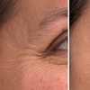 Image 8: Revitalize with 30 or 60 Units of Dysport at Youthful Glow