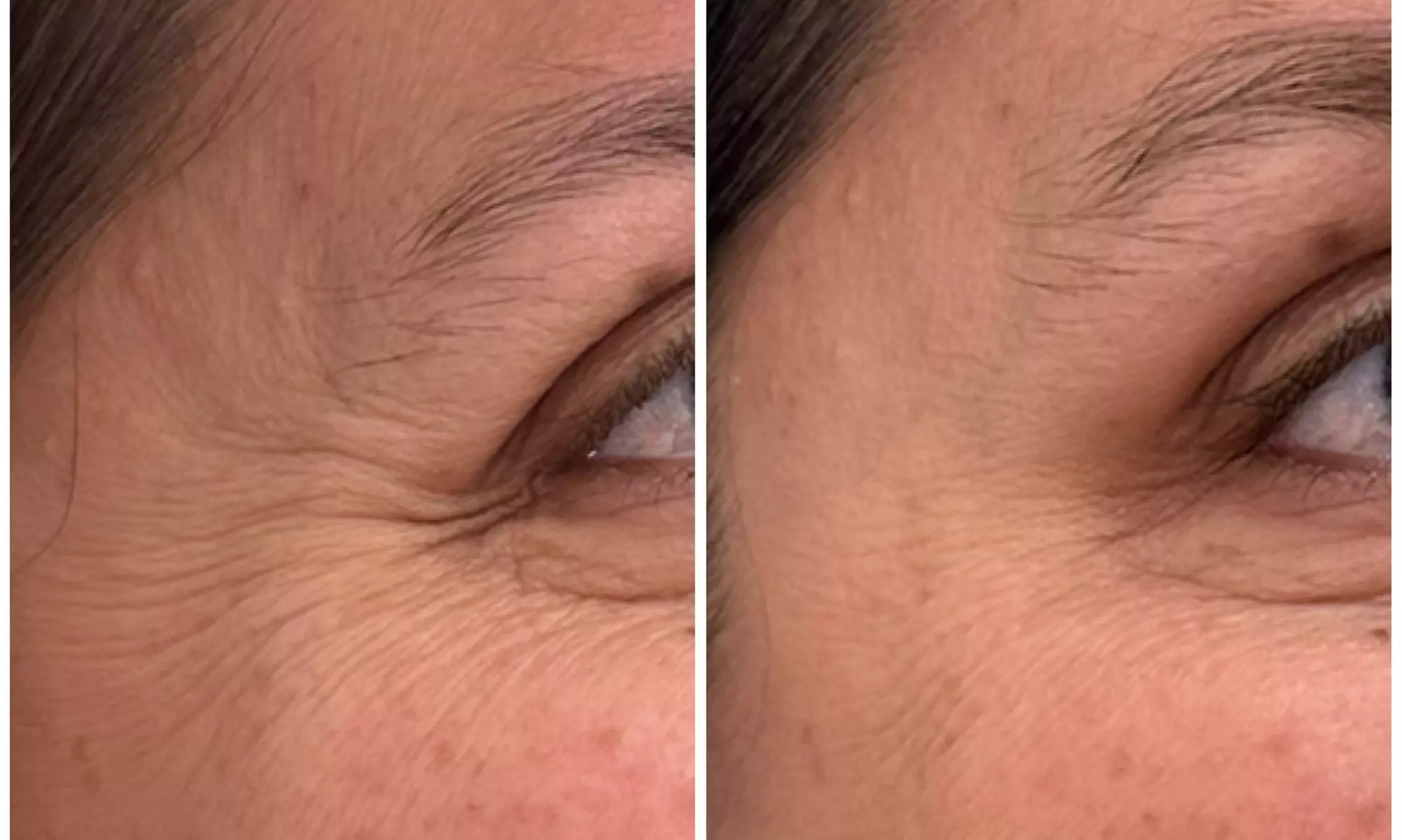 Revitalize with 30 or 60 Units of Dysport at Youthful Glow