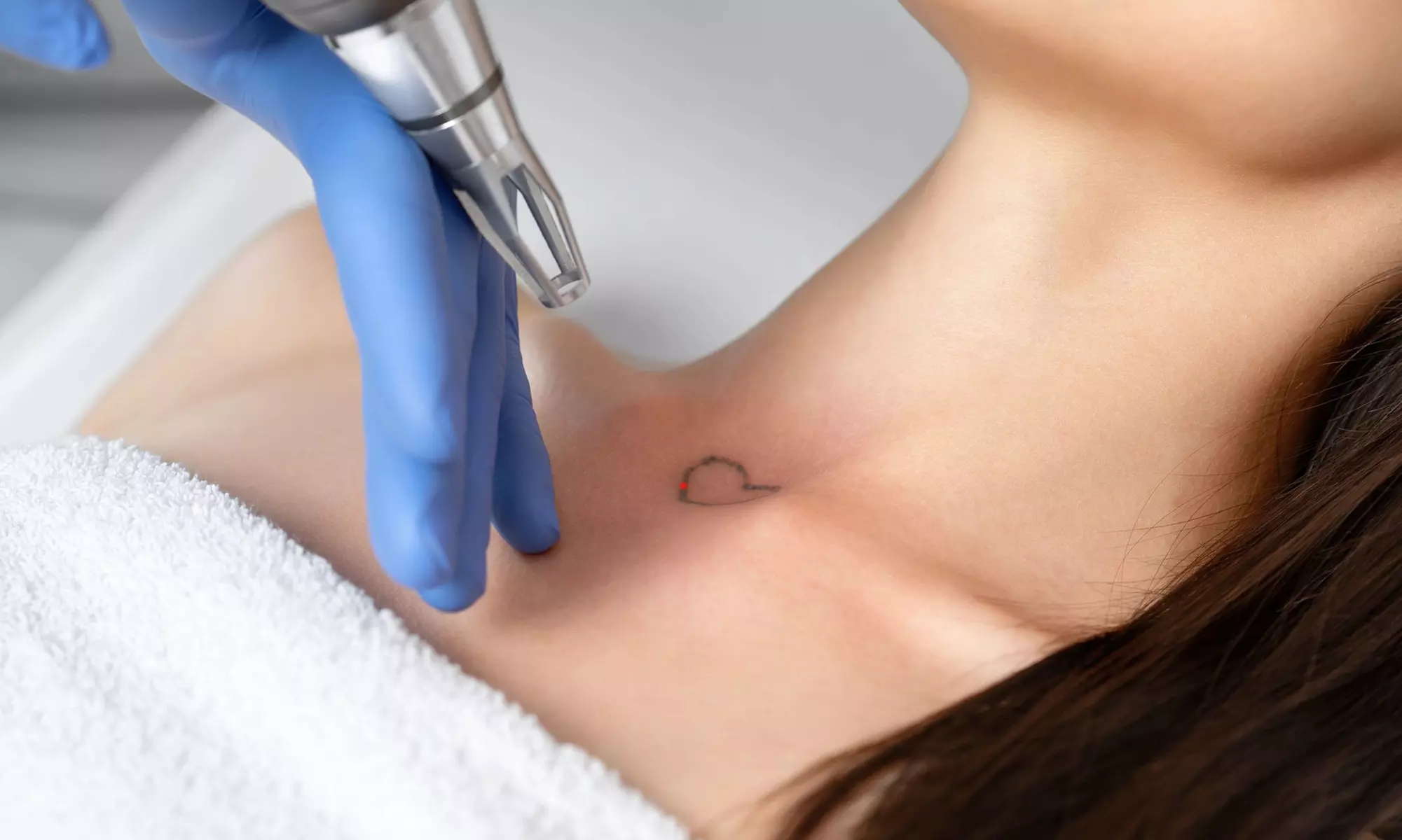 One or Three Laser Tattoo Removal for Small, Medium or Large Areas