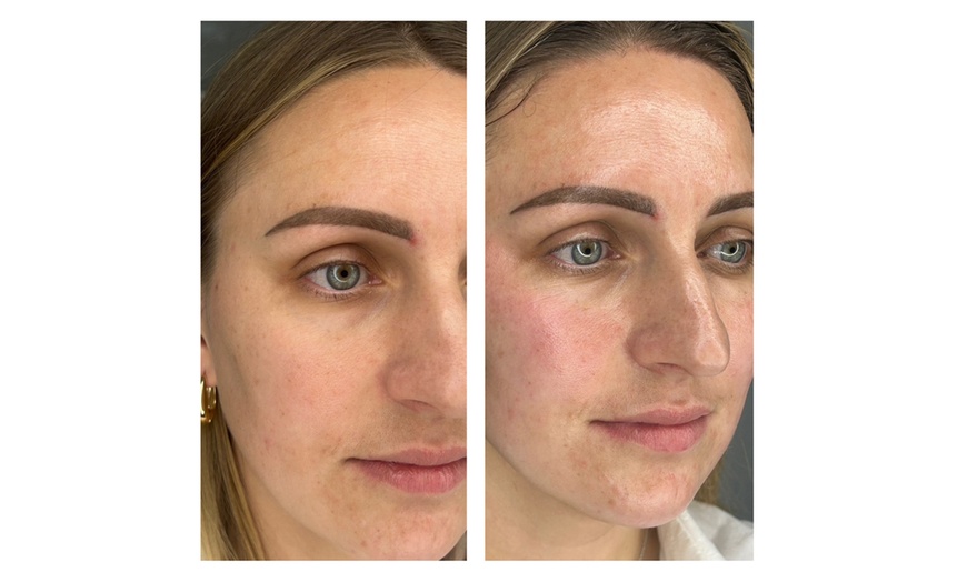 Image 7: Limpieza de cutis manual con tratamiento a elegir para 1 persona