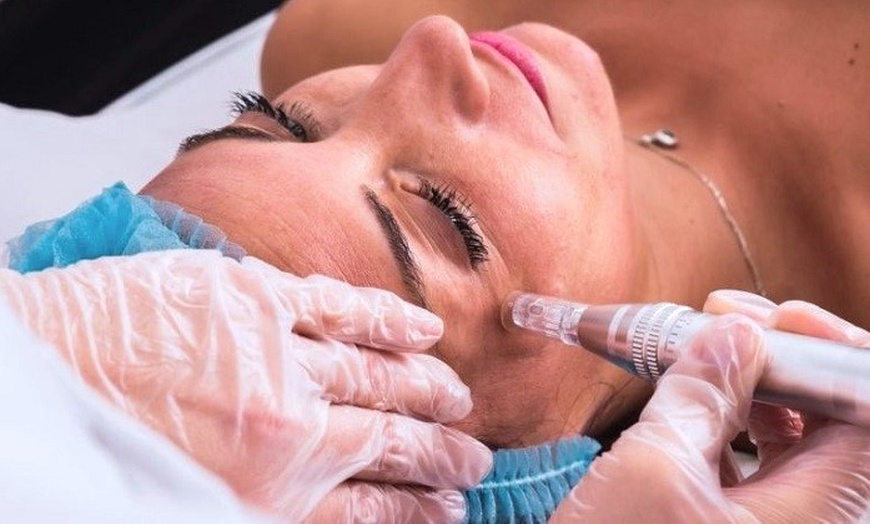 Image 9: 1, 2 o 3 sesiones de microneedling facial de vitaminas con Dermapen