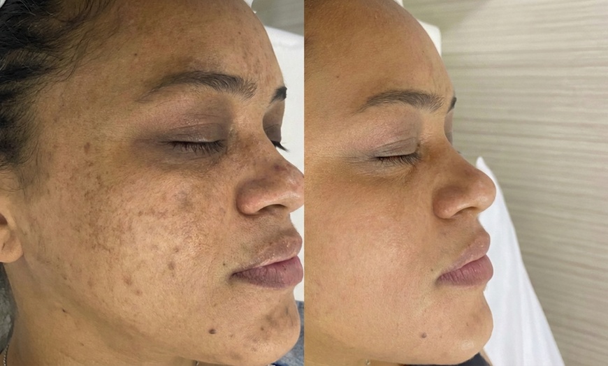 Image 3: Revitalize with One, Three, or Six Sessions of Micro-needling
