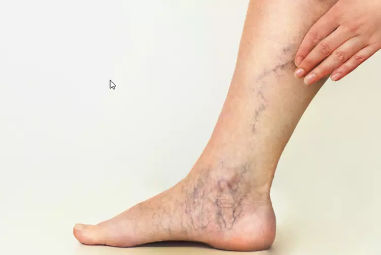  Laser Spider Vein Removal Treatment at Perfecta Cosmetic Clinic