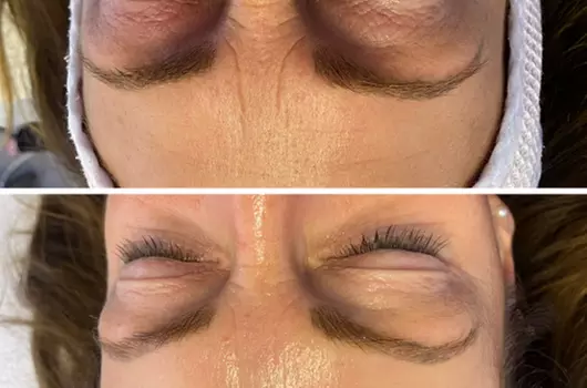 50-70 Min. Weihnachtsglow: HydraBoost-Gesichtsbehandlung für 1 Person