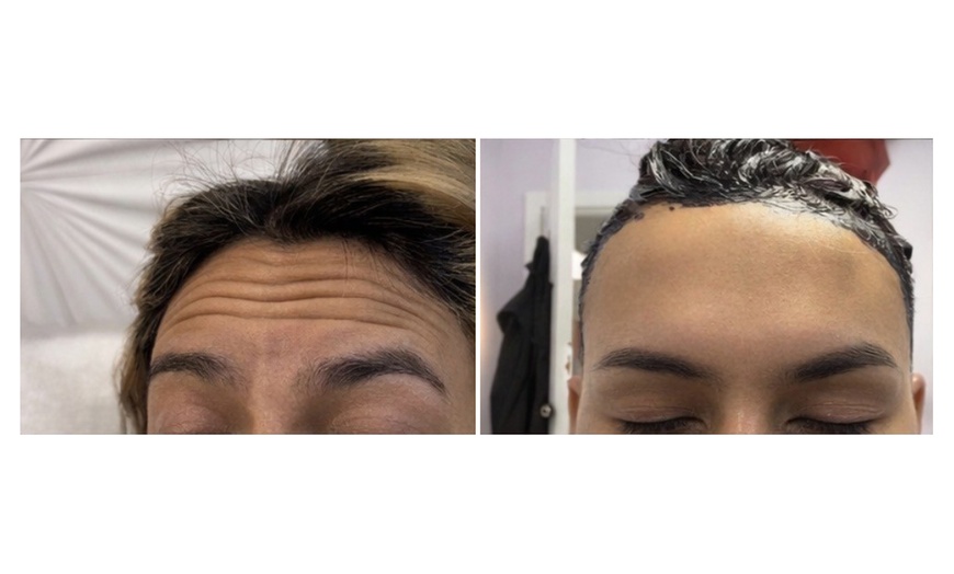Image 4: Enhance Yourself with 20, 40, or 60 Units of Botox