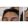Image 4: Enhance Yourself with 20, 40, or 60 Units of Botox