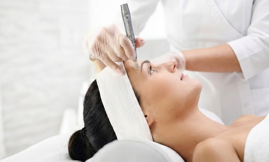 Image 2: Microneedling Treatments for Fine Lines, Wrinkles & Scars