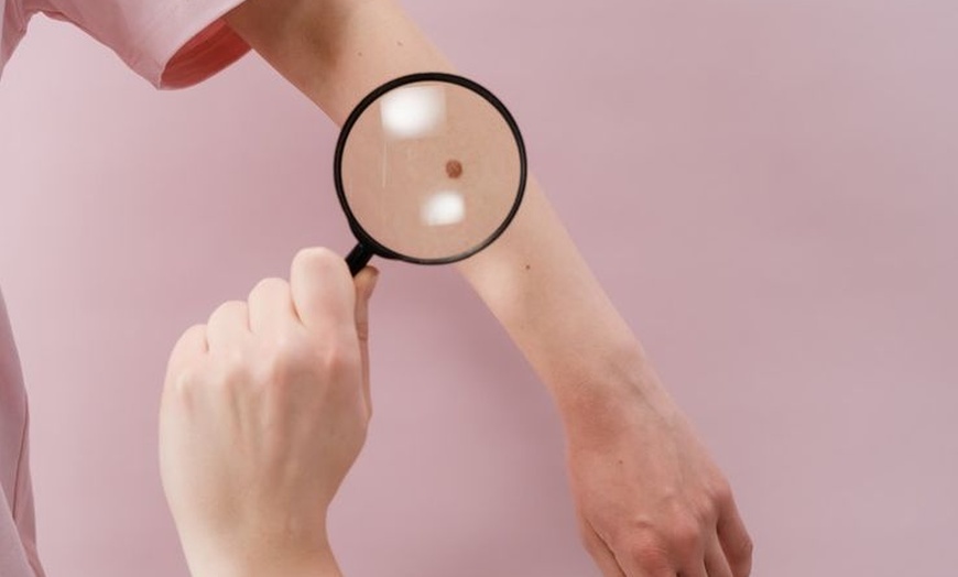 Image 6: Get clear skin with the removal treatment of moles, warts, skin tags, or brown spots at LuminUs at Boudica.