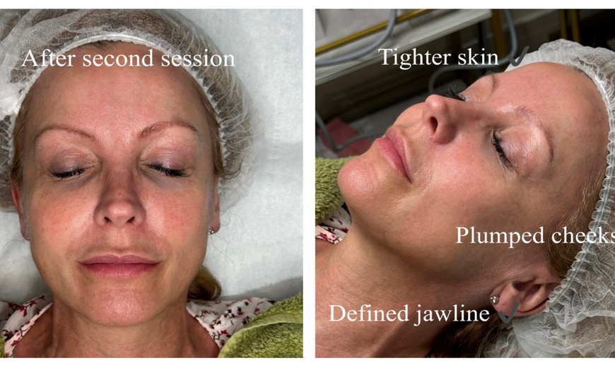 Image 4: Revitalize Skin w/ HIFU Face with Optional Body Area or Neck Treatment